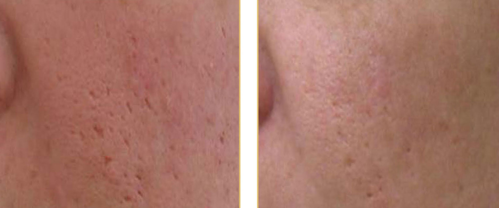 Ablative Laser Skin Resurfacing