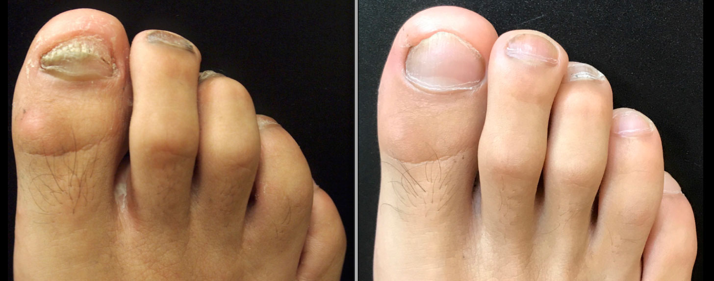 Fungal Nail Treatment