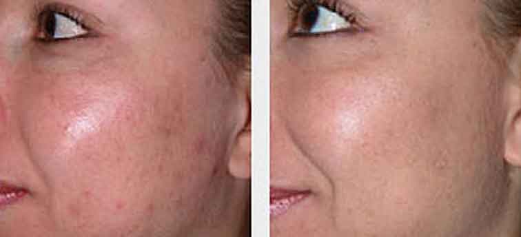 Microdermabrasion